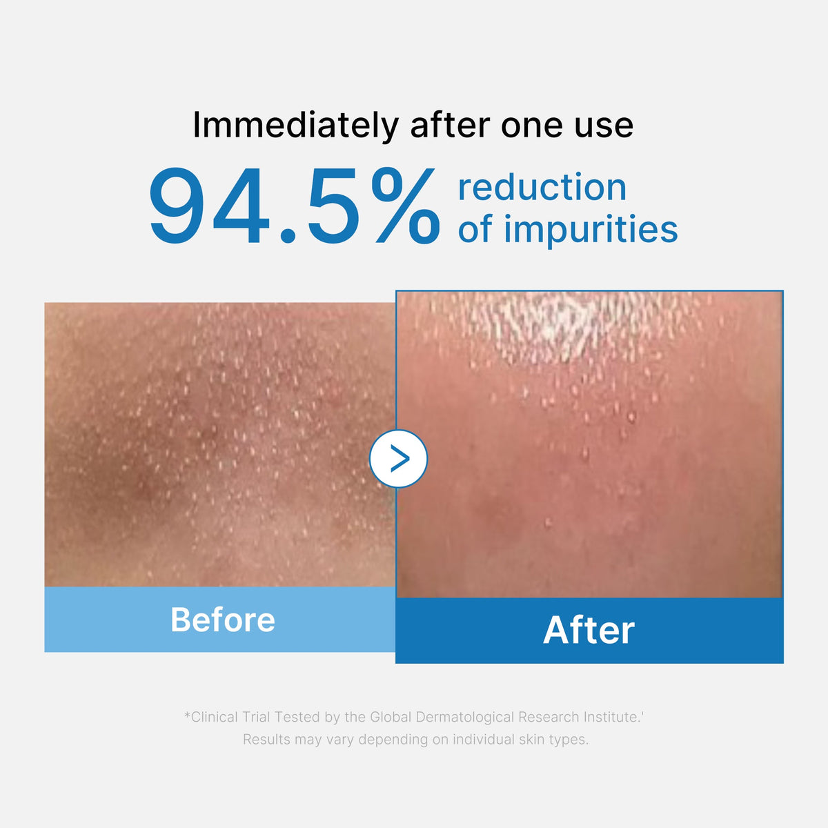 MEDICUBE Óleo de Limpeza Facial Zero Poros Anticravos